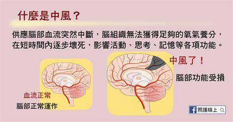 真杏通血路|缺血性腦中風 銀杏有助打通末梢血液循環